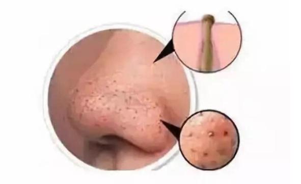 皮肤黑头有什么小偏方治,竹炭祛黑头面膜能去除黑头吗