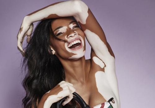 白癜风为啥夏季高发,白癜风夏季高发怎么治疗