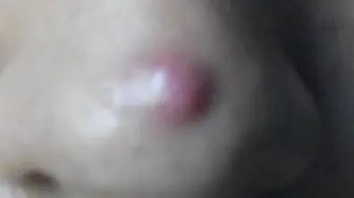 脸上老是长痘怎么祛痘,28岁了脸上老是长痘痘怎么办