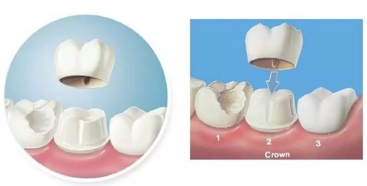 什么情况下牙齿需要做牙冠,牙齿抽掉神经需要戴牙冠吗