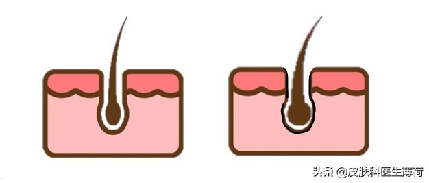 医生建议收缩毛孔的最好方法,医生清理毛孔