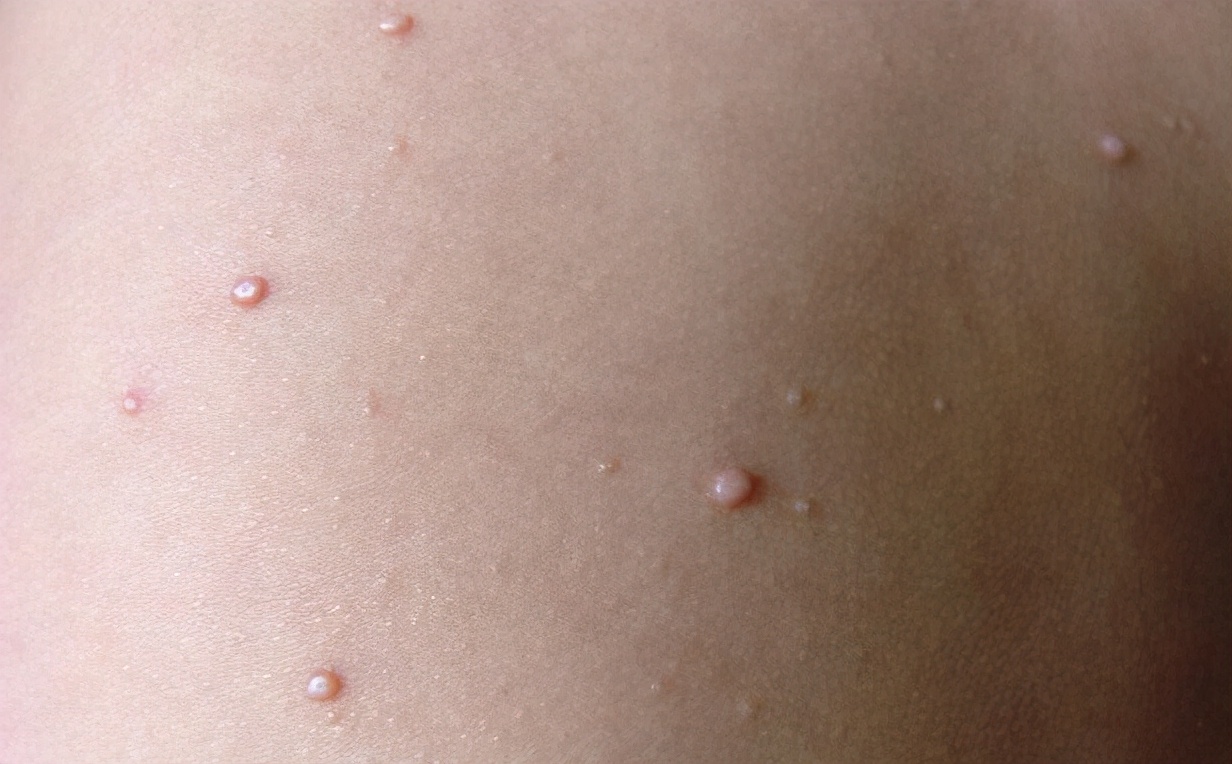 体表长肉疙瘩是病吗,私部长疮是什么病