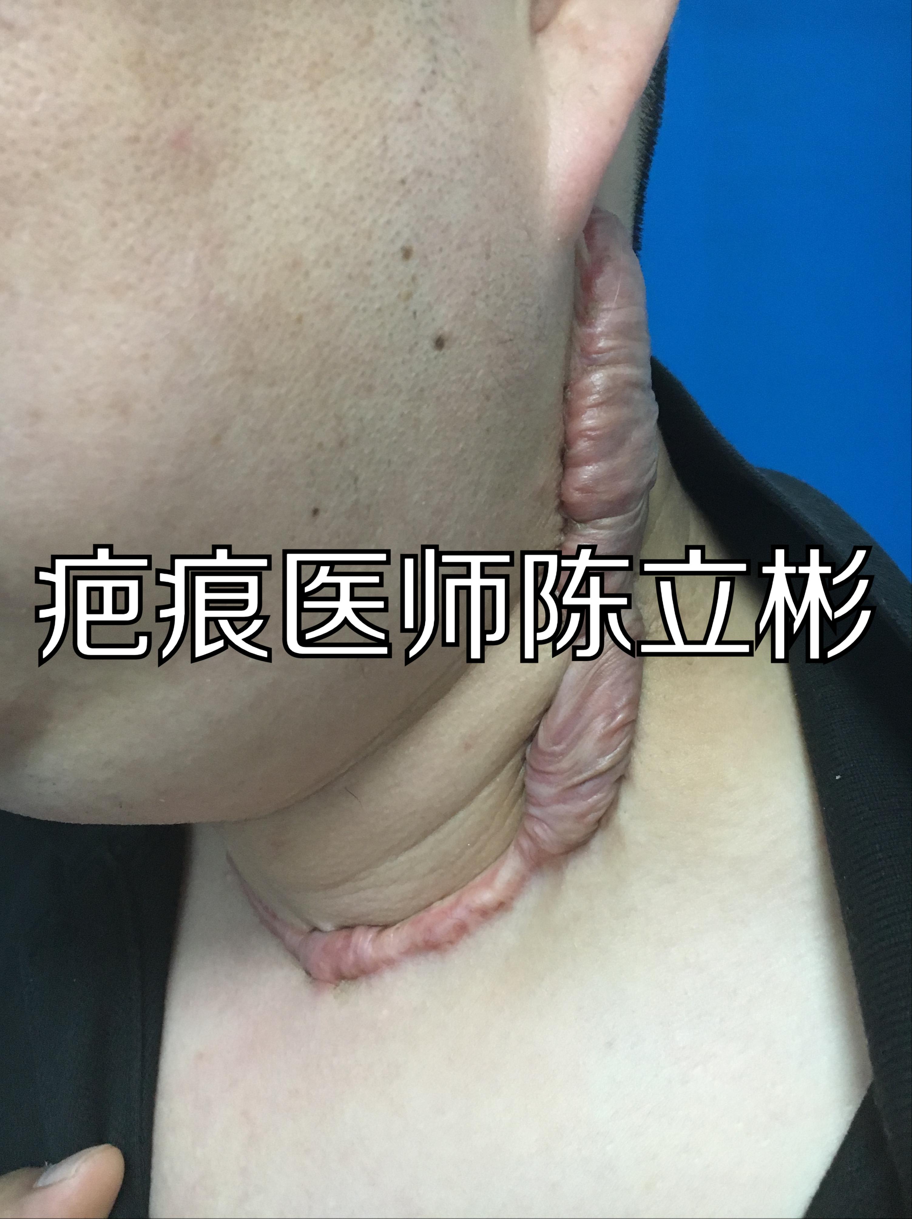 甲状腺结节手术后疤痕,祛甲状腺疤痕的小妙招