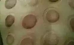 拔罐时出现罐印红是怎么回事,怎样快速消除拔罐留下的罐印