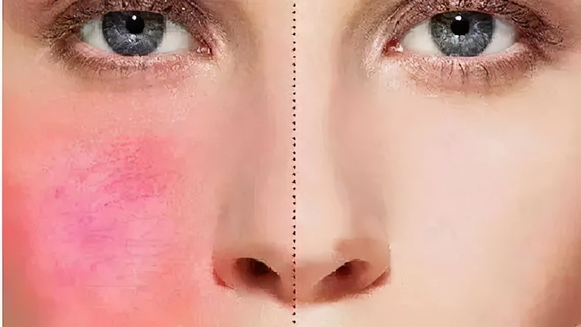 怎样修复敏感肌脸部突然发红,脸部发红敏感肌怎么治疗