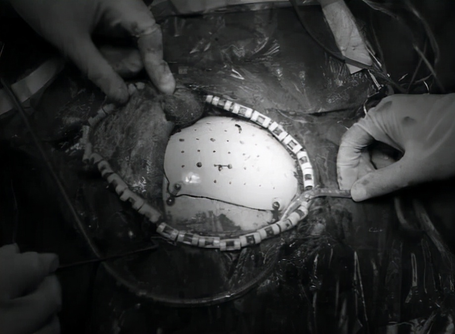 颅骨缺损?北京民航总医院朱安林告诉你如何正确的治疗