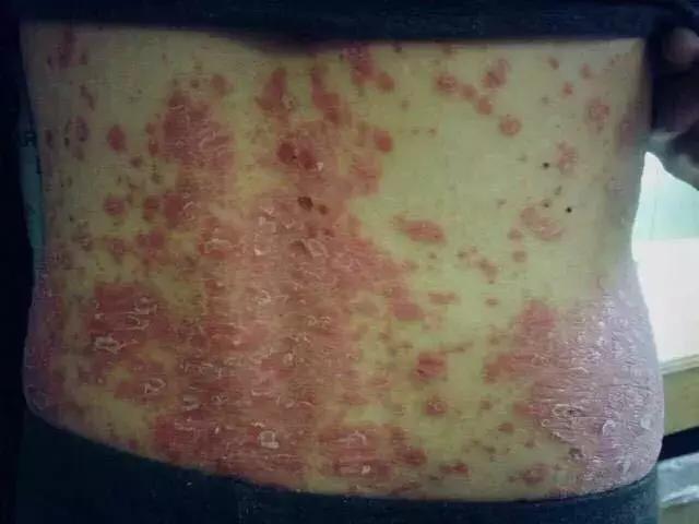 银屑病6大诱因自测表,银屑病机理研究