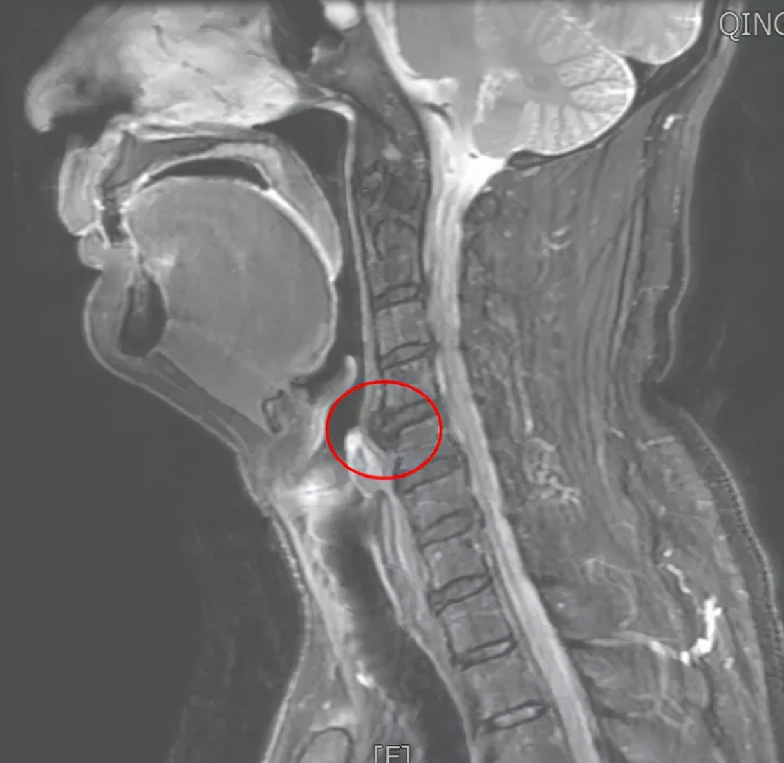 青岛62岁大爷咽不下饭，竟是颈椎骨上长了个“鸟嘴”