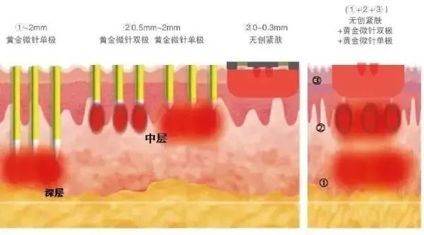 脸上不同部位长痘对应器官有问题,脸上长痘部位对应内脏