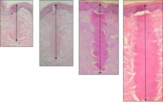 激光祛疤真的有效吗多少钱,激光祛疤痕是智商税吗