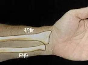 摔了一下手臂桡骨骨折,摔倒时手掌撑地引起手腕桡骨骨折