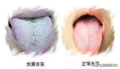 一招教你看舌苔6种舌苔你是哪种,身体好不好看嘴唇就知道了