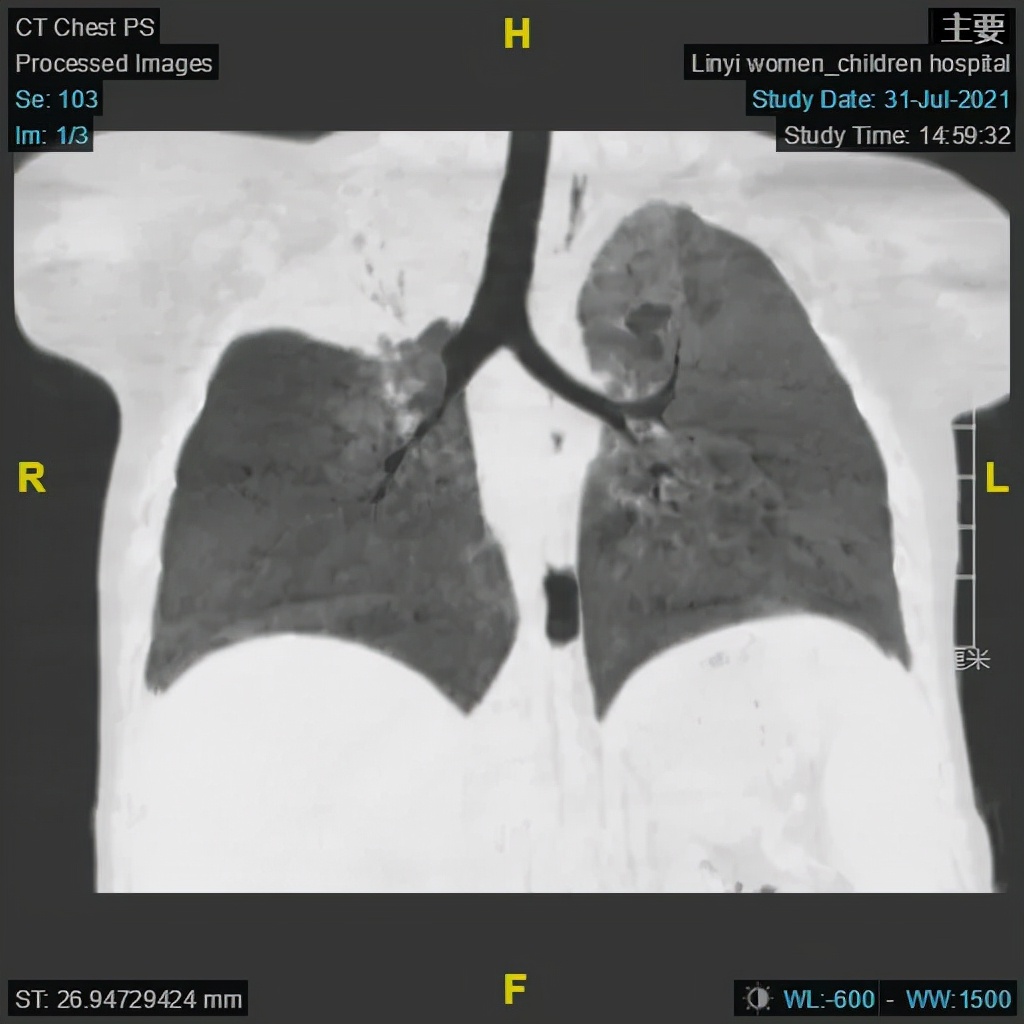 小孩肺炎支气管镜洗肺过程,肺炎总是不好怎么办