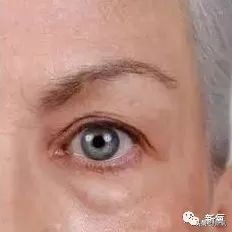 景甜修复之后的双眼皮是多宽,景甜修复后的双眼皮多宽