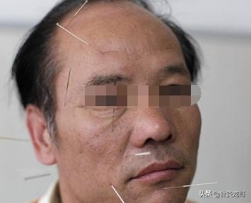 得了面瘫该如何治疗,得了面瘫该如何治有效