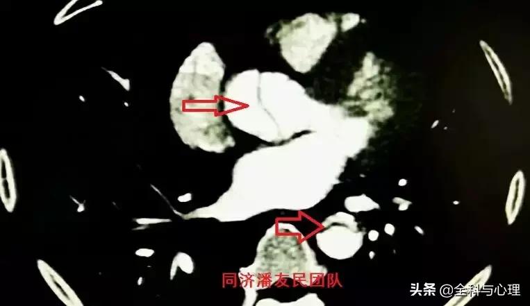 诊断主动脉夹层，千万别犯这种错误！