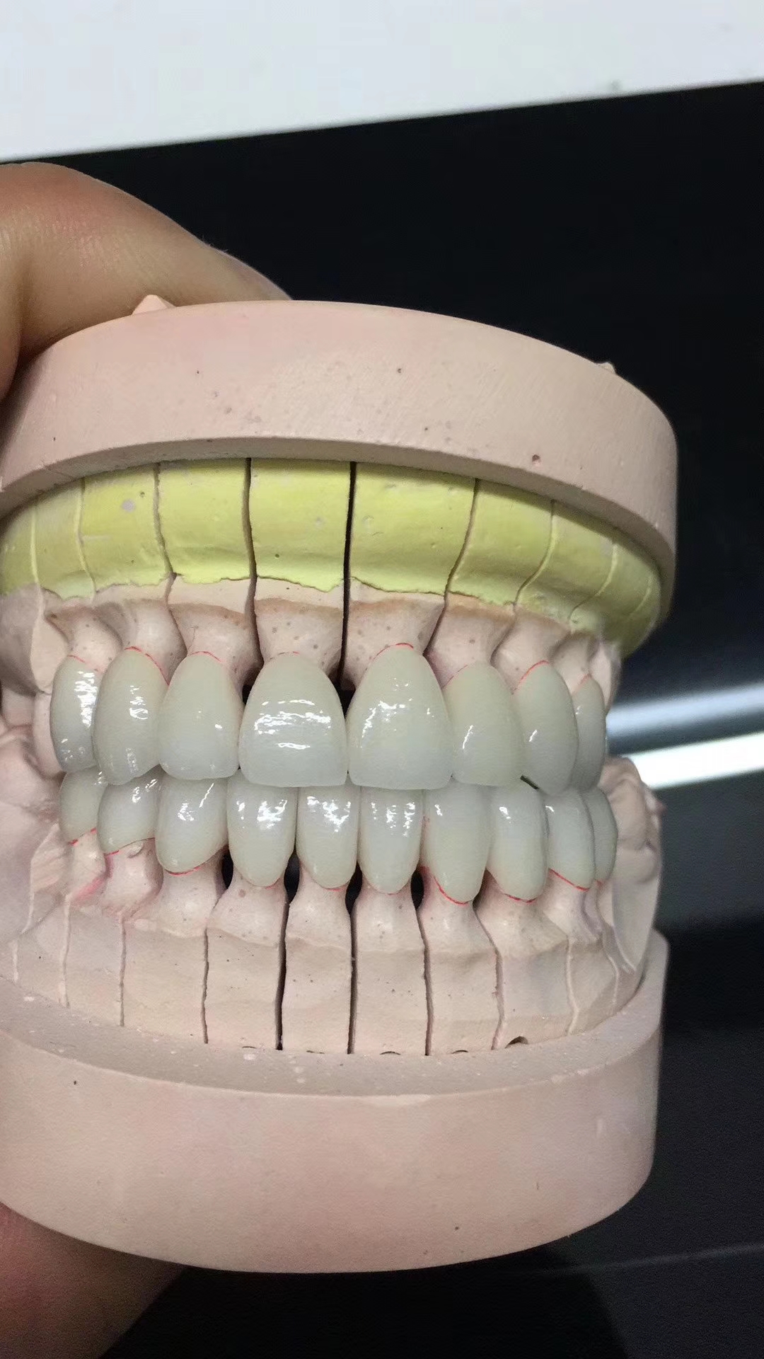 假牙套怎么种植牙,戴的假牙套与全瓷牙的感觉