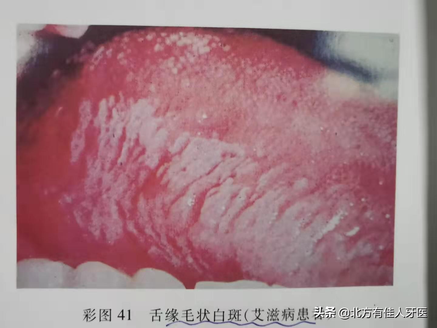 一张嘴就能看出是否得艾滋病,你知道怎么诊断和鉴别诊断吗?