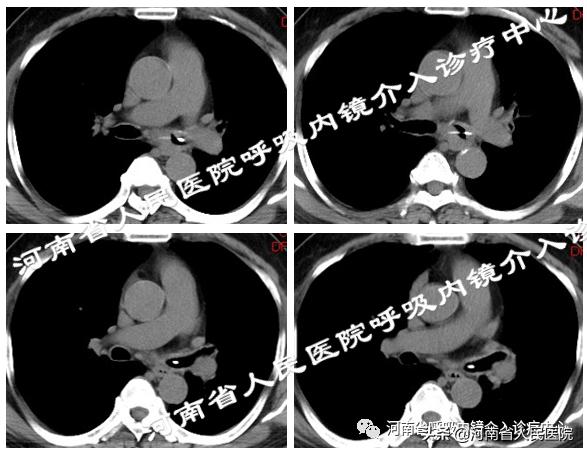一年前吃的甲鱼骨，竟在气管里成了要命的“回旋镖”