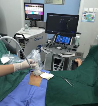 什么是癌症冷冻治疗？对比其他微创介入技术，冷冻治疗有哪些优势