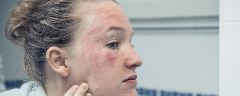 痘痘肌肤怎么改善学生,痘痘肌肤怎么改善最新方案