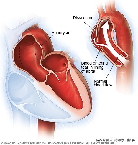 胸主动脉瘤最常见的护理措施,胸主动脉疾病
