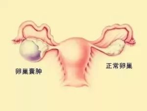 三种常见的妇科问题不影响怀孕,4种妇科病