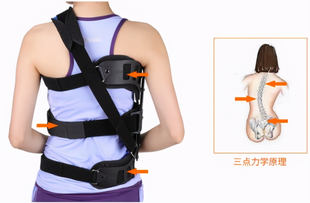 脊柱侧弯戴矫正支具可以报销吗,脊柱侧弯支具治疗的流程