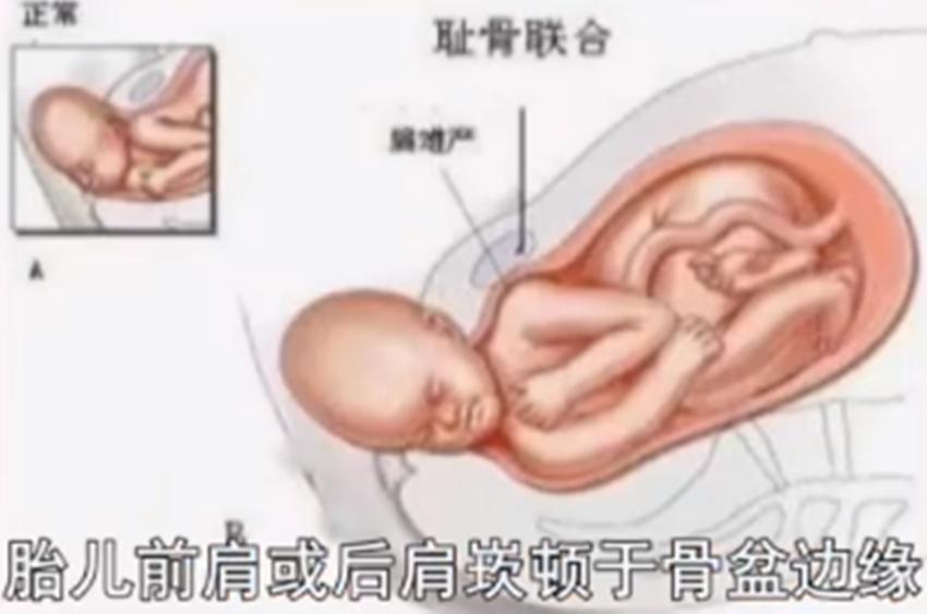 孕妇难产一般是什么原因,难产的孕妇