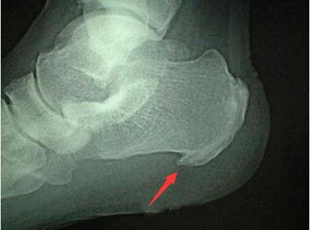 膝盖骨质增生怎样治疗最快,颈椎骨质增生怎么治疗最好