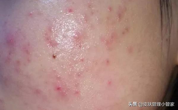 祛斑祛痘皮肤管理,皮肤管理祛痘有效吗