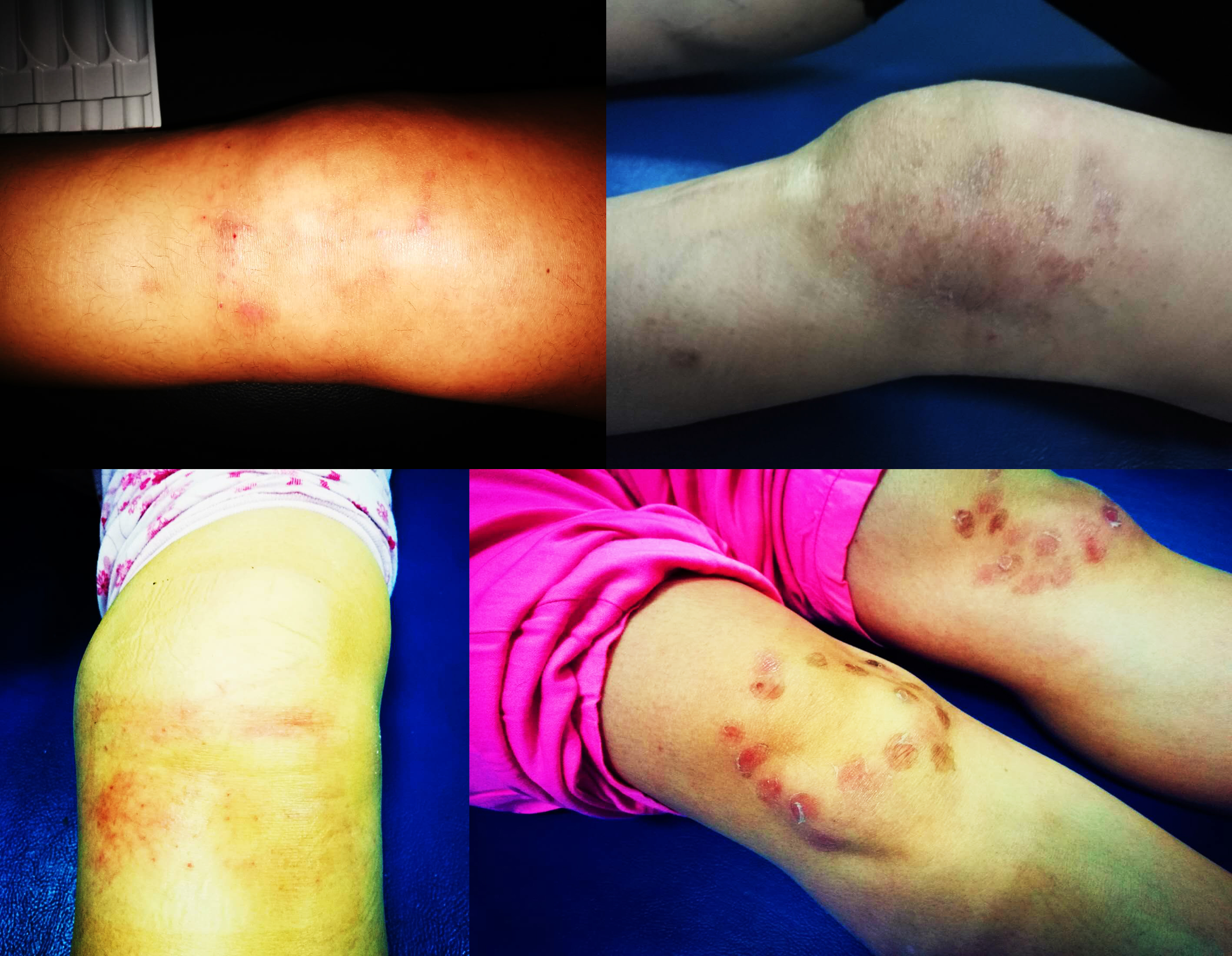 膝盖积水用烤灯能烤好吗?粗盐呢?医生:明确诊断针对治疗是关键