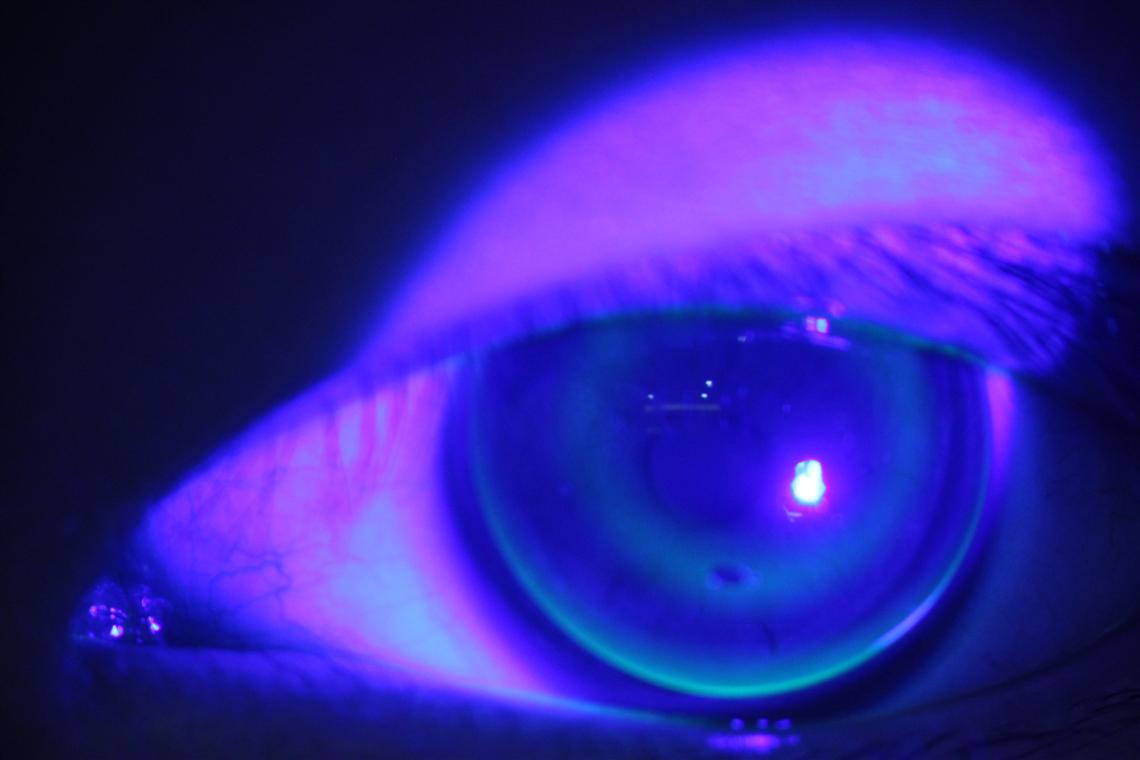 角膜散光大者一定不能配戴角膜塑形镜么？