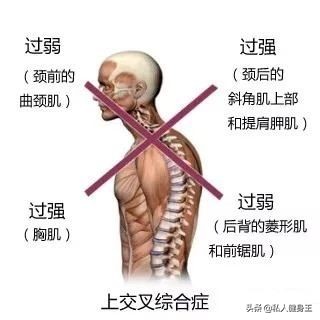 如何矫正驼背的正确方法,驼背怎么办五个动作帮你改正驼背