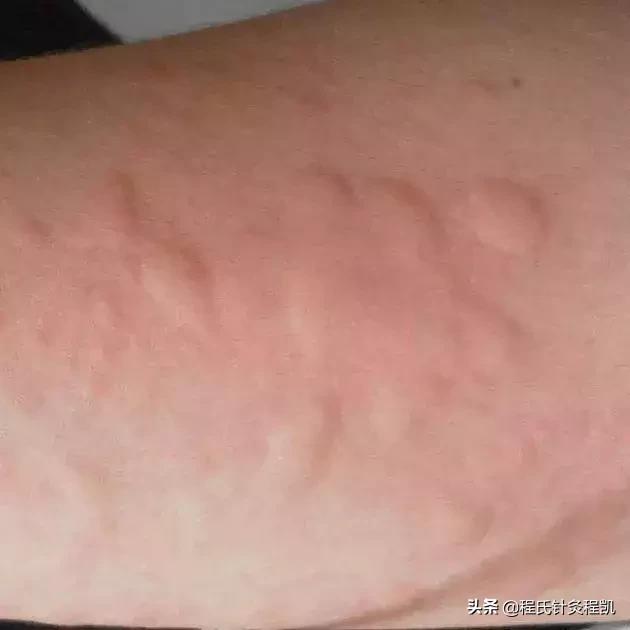 小儿荨麻疹中医反射推拿,荨麻疹夏季如何预防虫咬皮炎