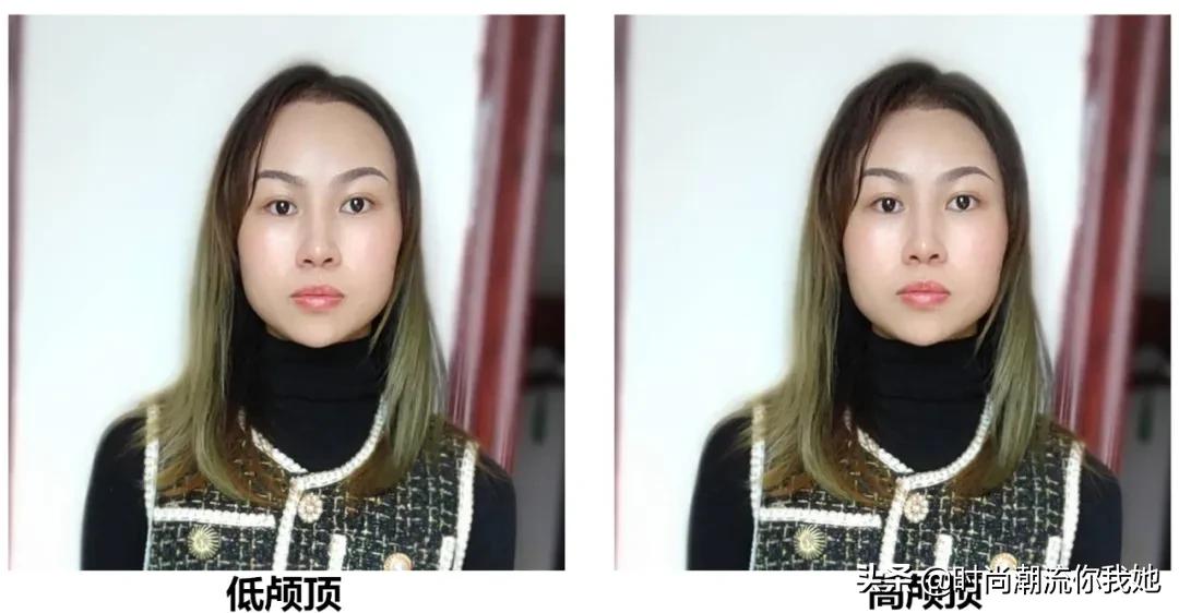 单眼皮凸嘴素人改造,肿眼泡整容成功案例