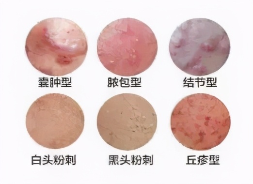 正在长痘痘可以用哪些护肤品,祛痘痘的很有效的药膏推荐