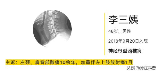 颈椎病治疗的分享,关于颈椎病通俗易懂的科普