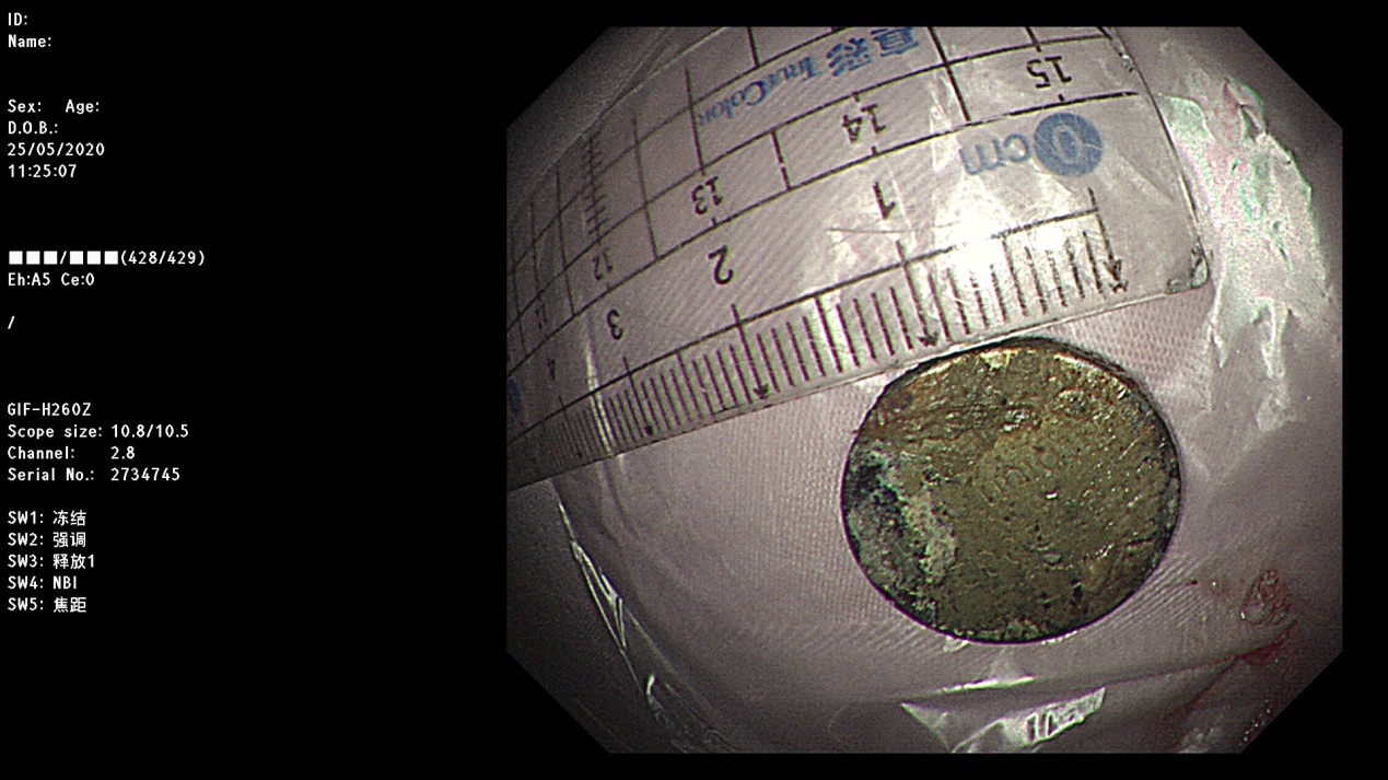 6岁儿童吞了一个纽扣怎么办,2岁宝宝吞了塑料纽扣能排出来么