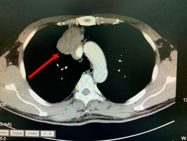 胸腔里长了个九厘米瘤子怎么回事,胸腔食管外面长个拳头大小瘤