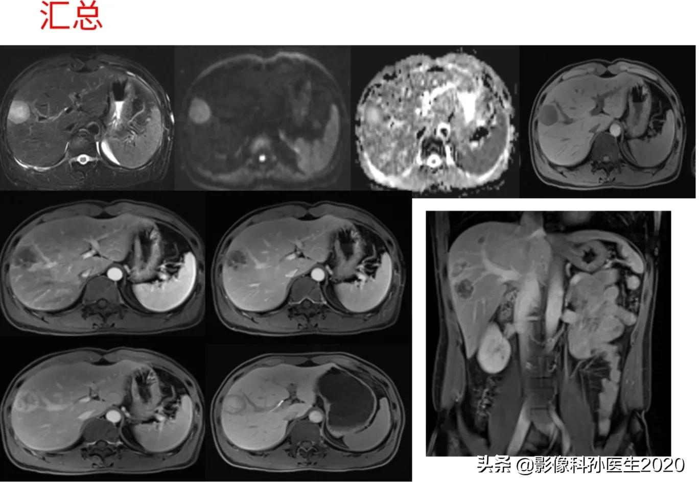 肝上皮样血管内皮瘤全国多少例,肝上皮样血管内皮瘤超声表现
