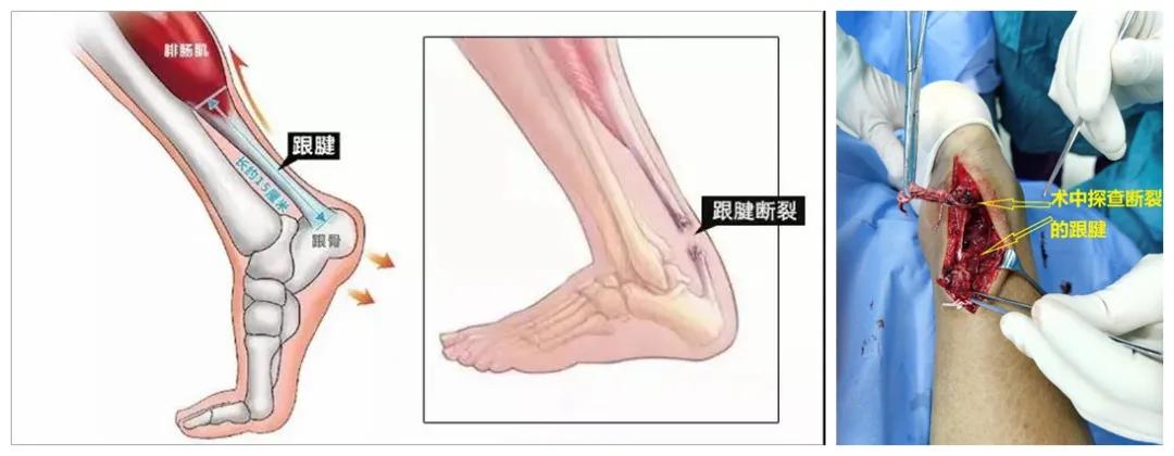 跟腱阿喀琉斯,跟腱撕裂的阿喀琉斯