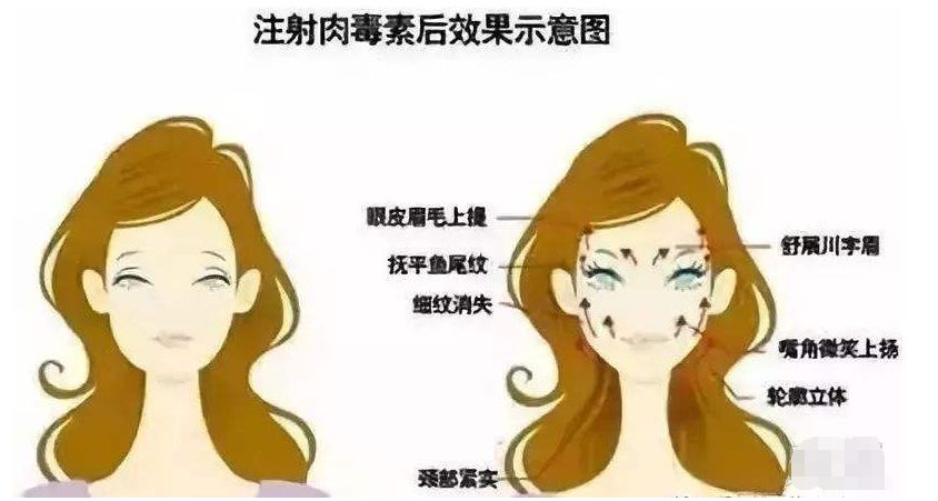 肉毒素科普视频,怎样知道肉毒素医生打了多少