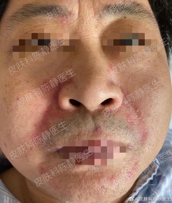 鼻头发红是日光性皮炎还是酒渣鼻,鼻头隐约有点红