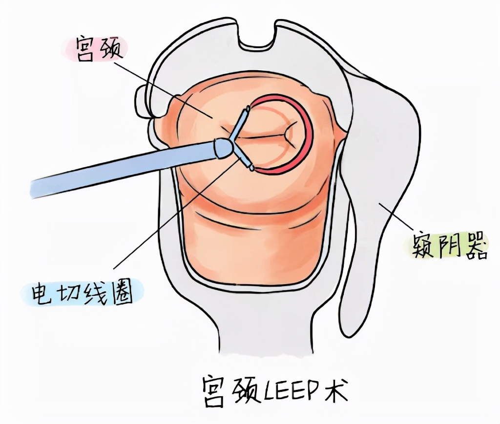 我在美国的治癌经历,hpvcin3国外如何治疗