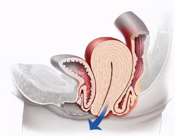 直肠脱垂会自己恢复吗,直肠脱垂怎么能自行恢复