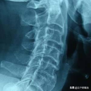 脊椎退化性改变,脊椎退化怎么治疗效果最好