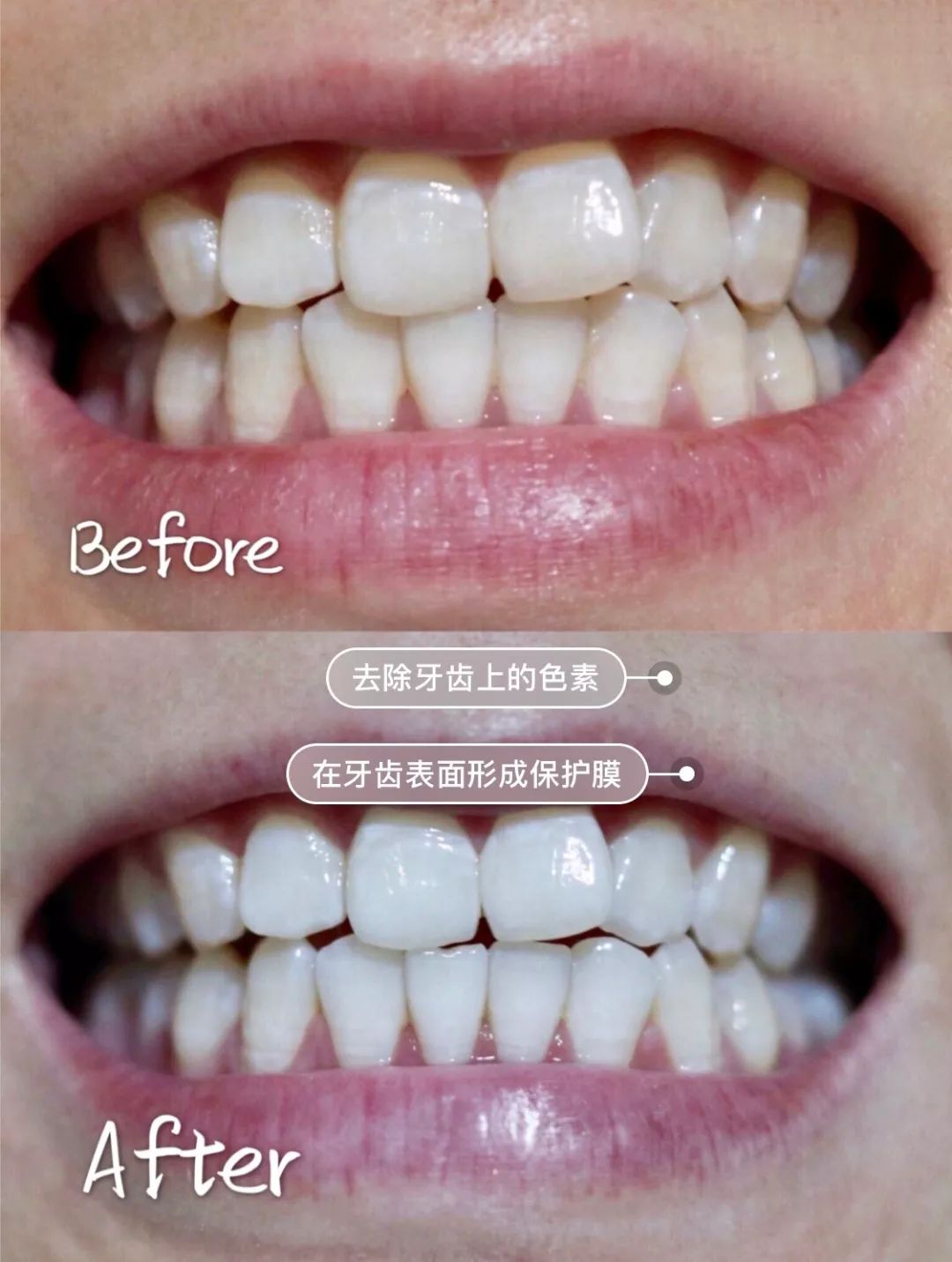 刘涛是全口瓷牙,演员刘涛的一口烤瓷牙多少钱