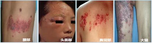 生蛇有什么急救方法吗,生蛇要注意些什么