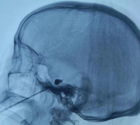 三叉神经痛需要抗癫痫治疗吗,癫痫引起的三叉神经痛怎么治疗